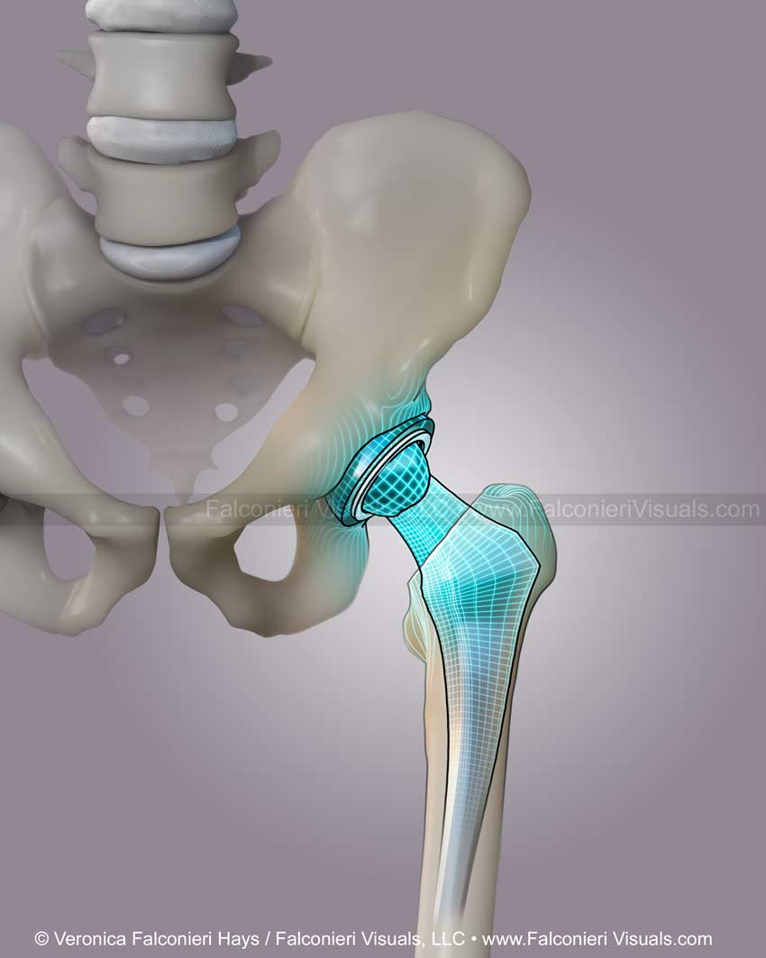 hip replacement